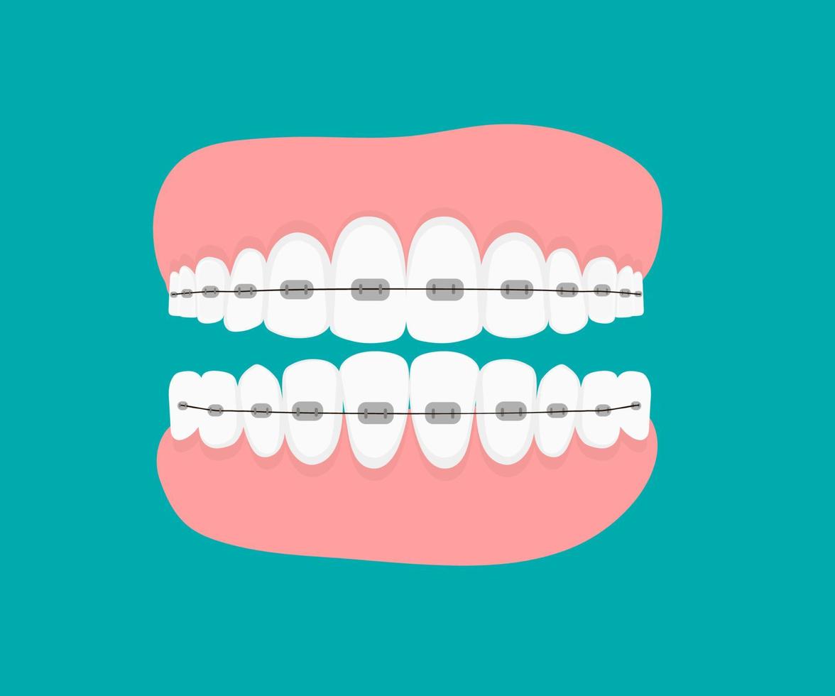 tanden met braces.flat vectorillustratie. kaken geïsoleerd. orthodontische behandeling beugels op tanden. tandheelkunde en orthodontie. tandheelkundige rij met met beugels vector