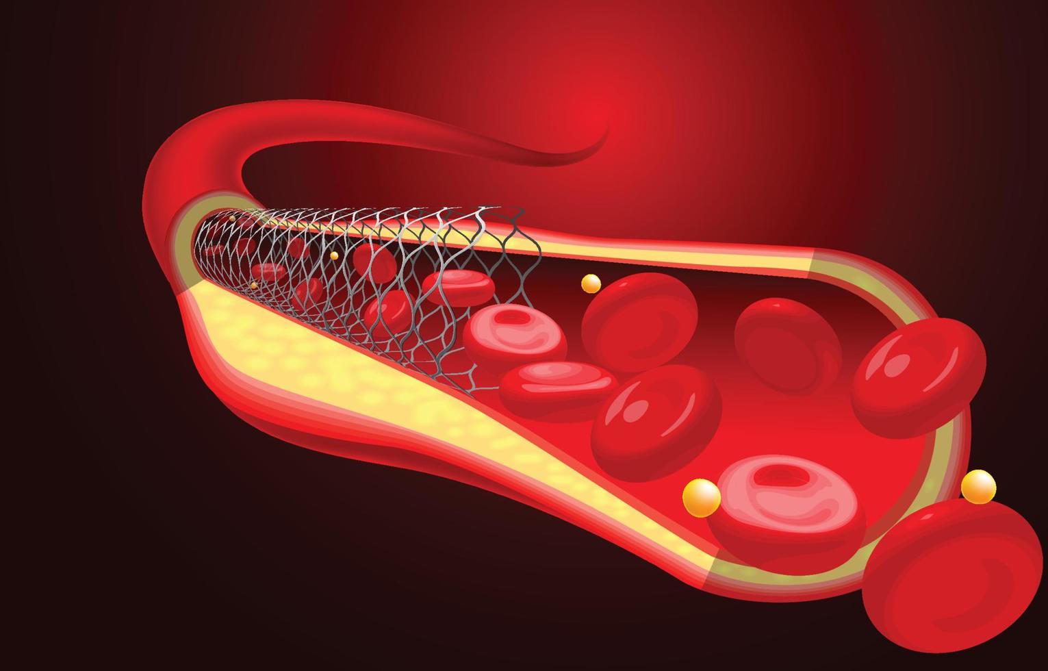 medische en educatieve illustraties van de reeds geplaatste stent. vector