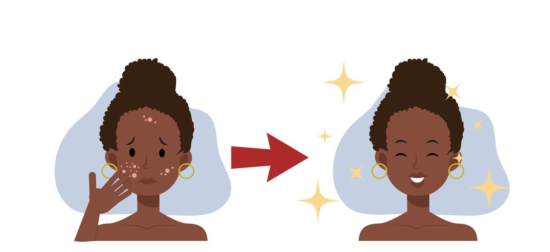 behandel acne, huidprobleem, puistje .african american woman face.beautyful. platte vector 2d cartoon karakter illustratie. Voor na