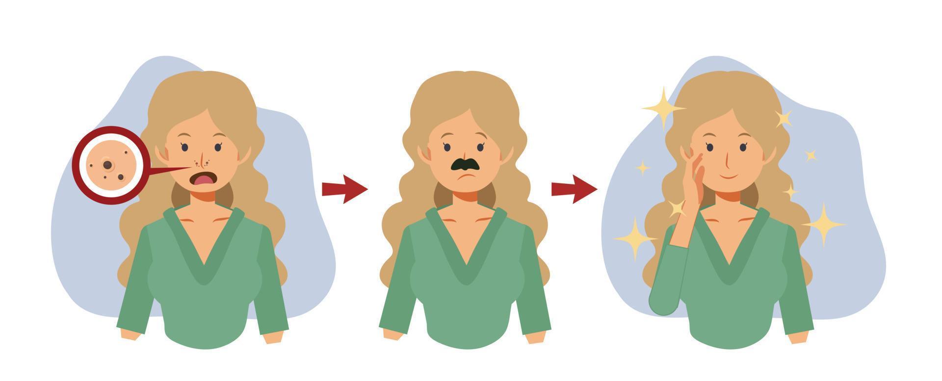 gezichtshuid behandeling concept, acne problem.acne op nose.step van een vrouw acne verwijderen uit haar neus platte vector cartoon karakter illustratie.