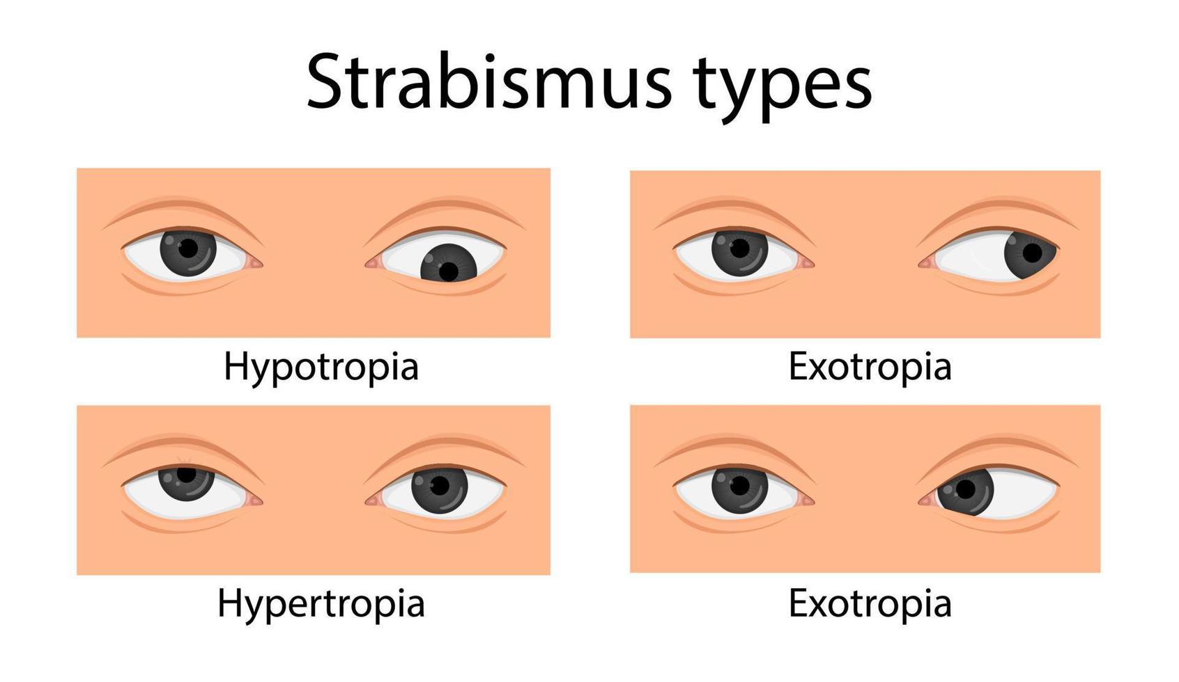 soorten scheelzien. hypotropie, hypertropie, exotropie, esotropie. cartoon stijl vector