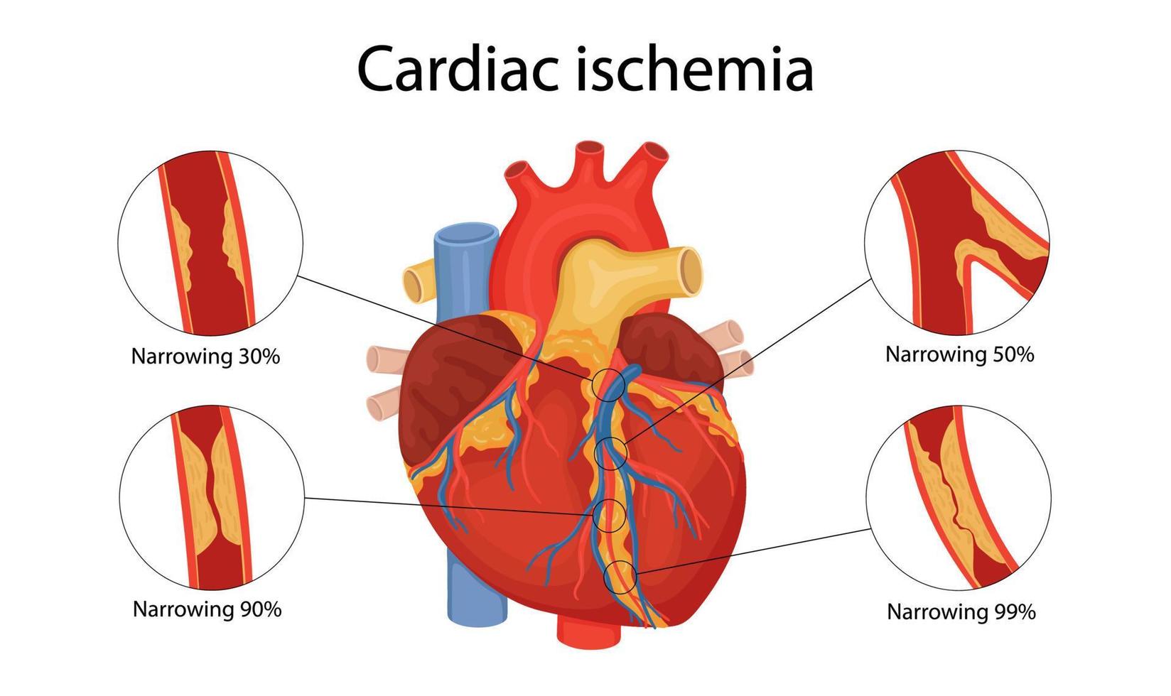 cardiale ischemie. anatomische illustratie getekend in cartoonstijl vector