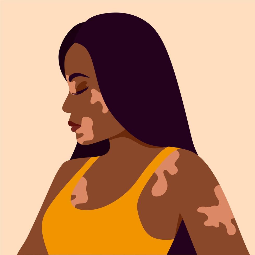 vitiligo is een jonge vrouw met een donkere huidskleur en huidproblemen. huidziektes. het concept van wereld vitiligo dag. verschillende huidskleuren van vrouwelijke personages. voor een blog, artikelen, banner, tijdschrift. vector