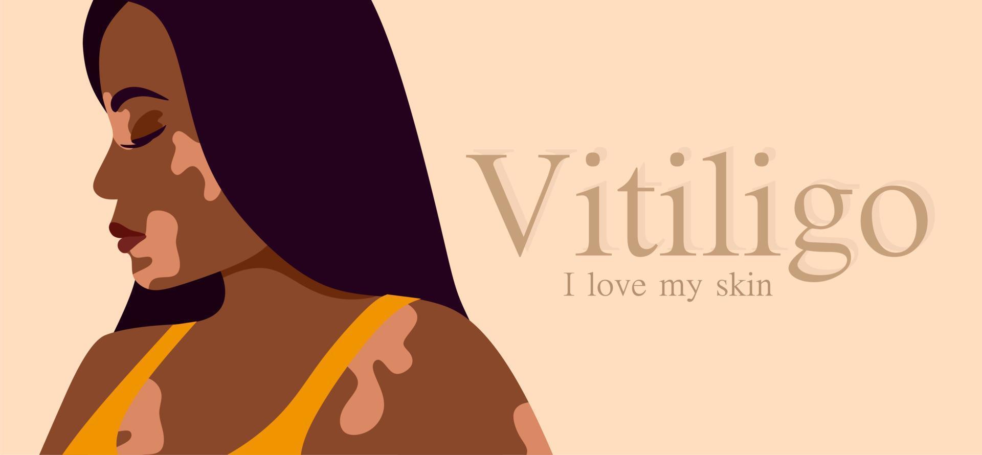 vitiligo is een jonge vrouw met een donkere huidskleur en huidproblemen. huidziektes. het concept van wereld vitiligo dag. verschillende huidskleuren van vrouwelijke personages. voor een blog, artikelen, banner, tijdschrift. vector
