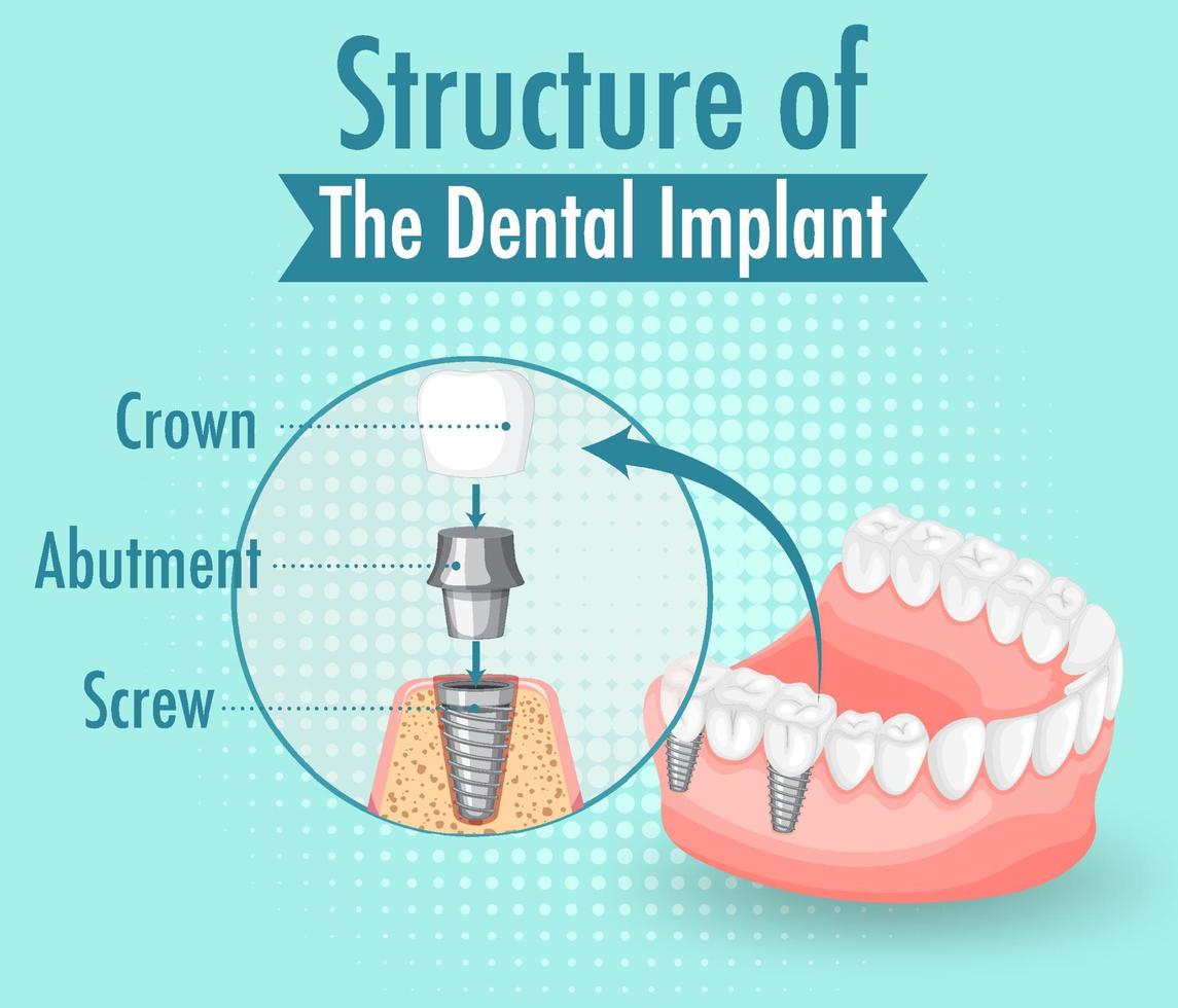 infographic van de mens in de structuur van het tandheelkundig implantaat vector