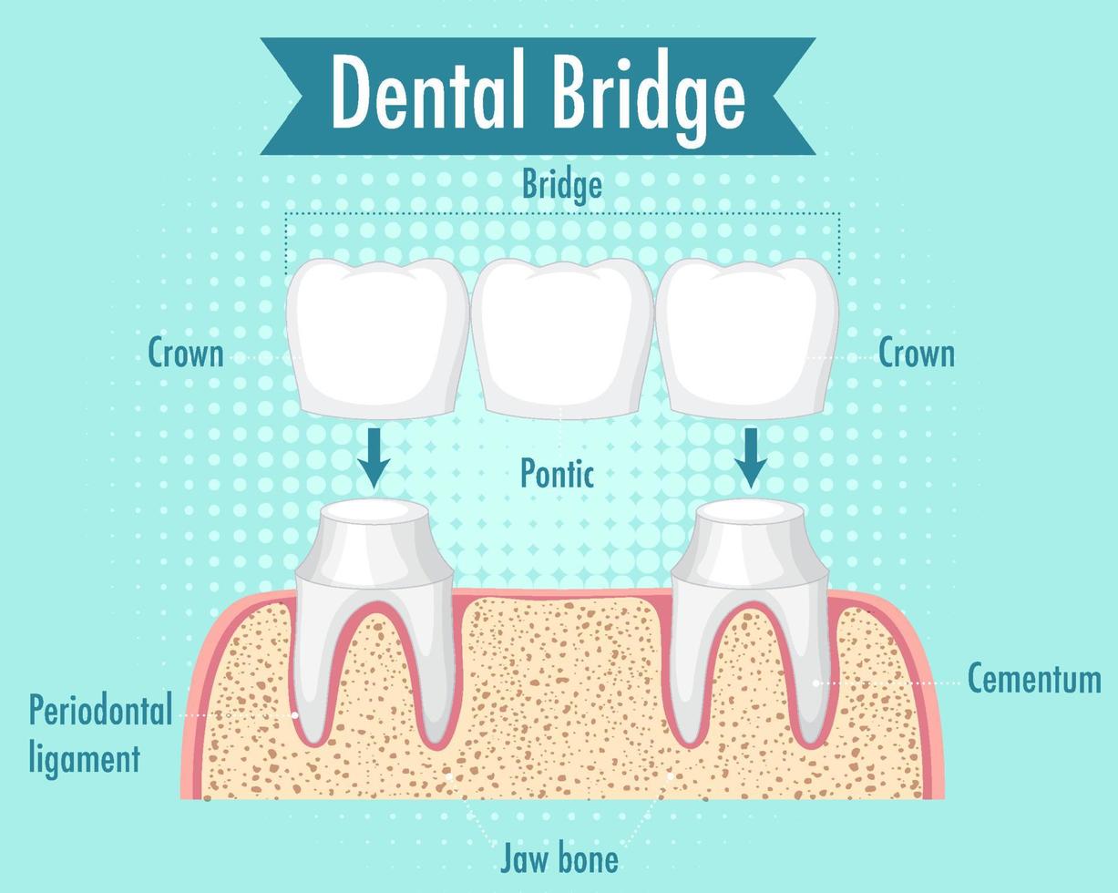 infographic van mens in tandbrug vector