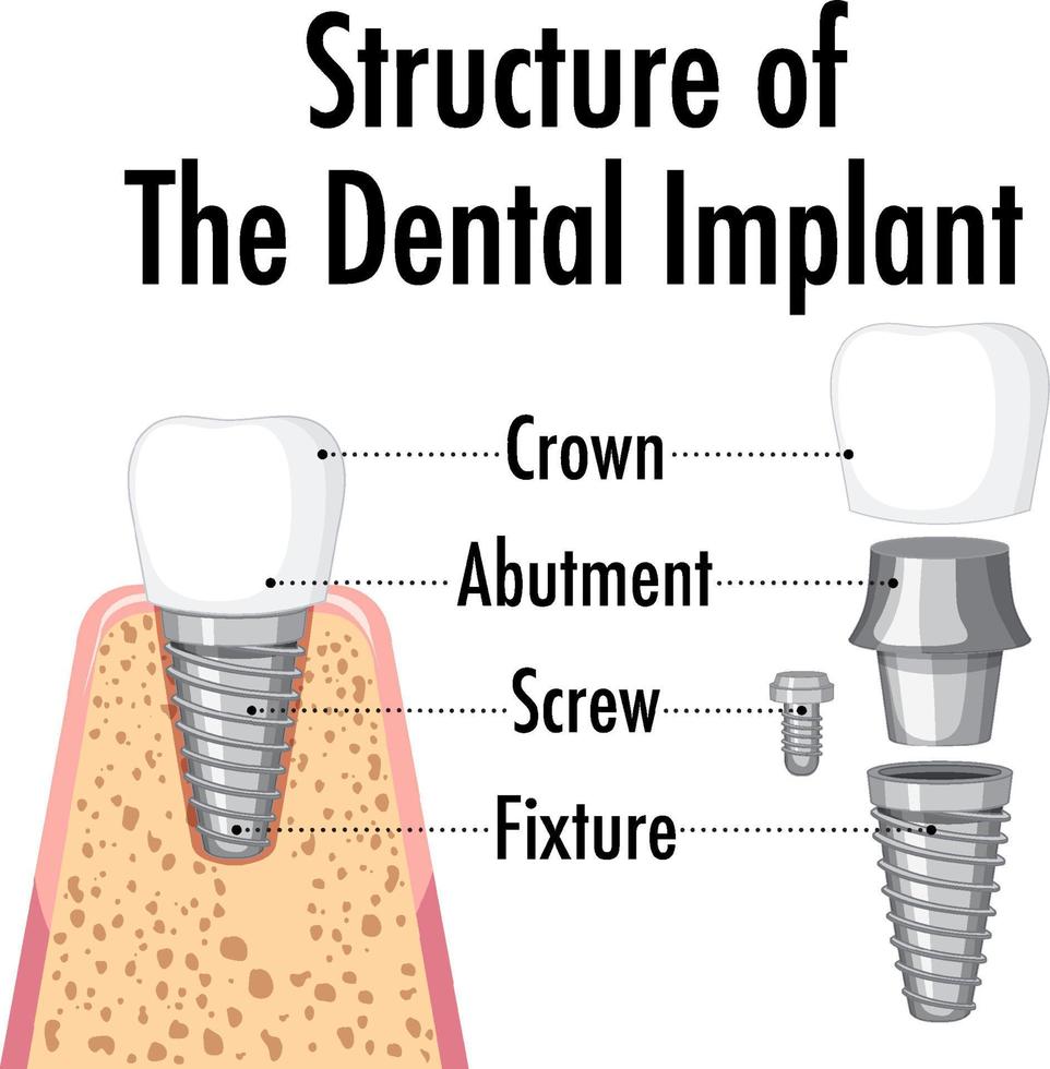 infographic van de mens in de structuur van het tandheelkundig implantaat vector