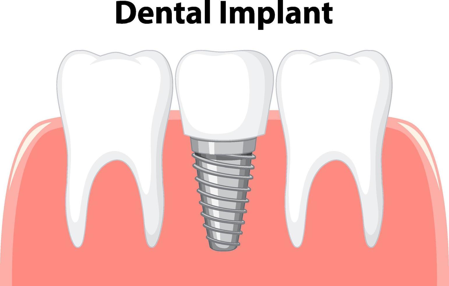 tandheelkundig implantaat in kauwgom op witte achtergrond vector