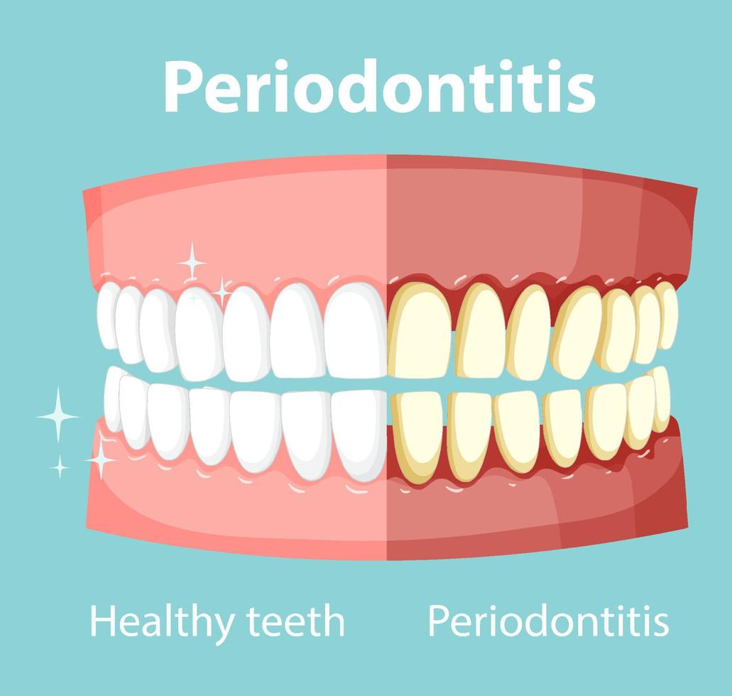 infographic van mens met parodontitis vector