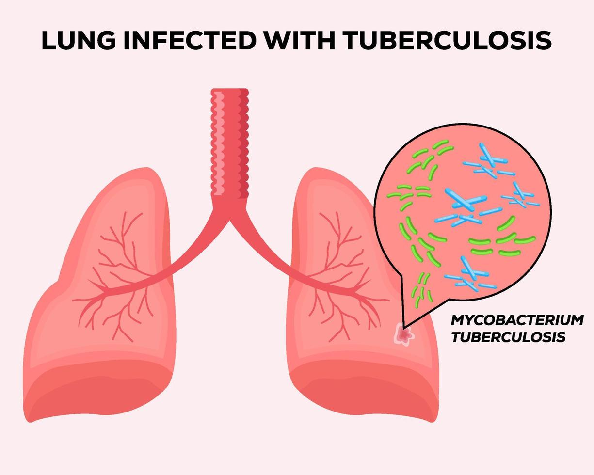 menselijke longen besmet met tuberculose vector