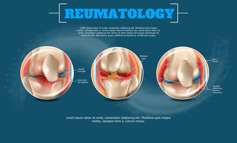 Realistische banner illustratie reumatologie vector