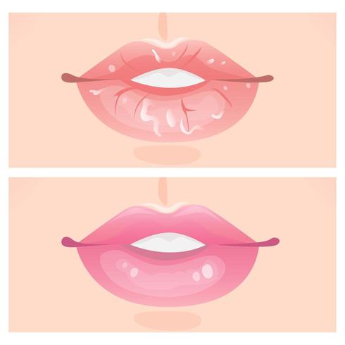 Schilferige lippen en mooie lippen vector