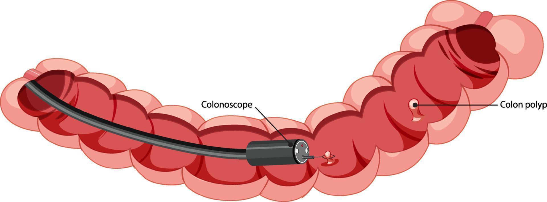 diagram met de binnenkant van de dikke darm met colonoscope vector