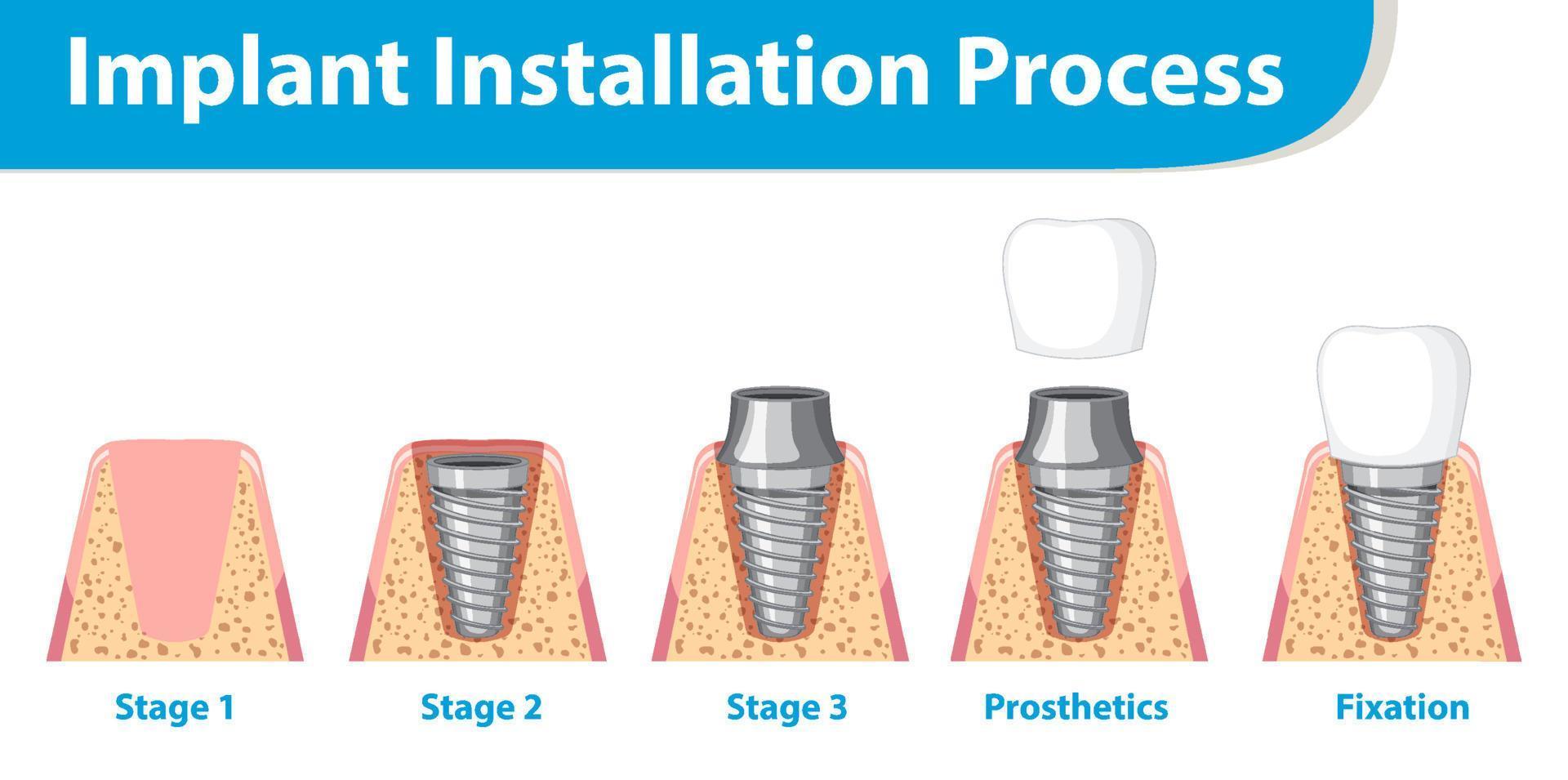 infographic van mens in implantaatinstallatieproces vector