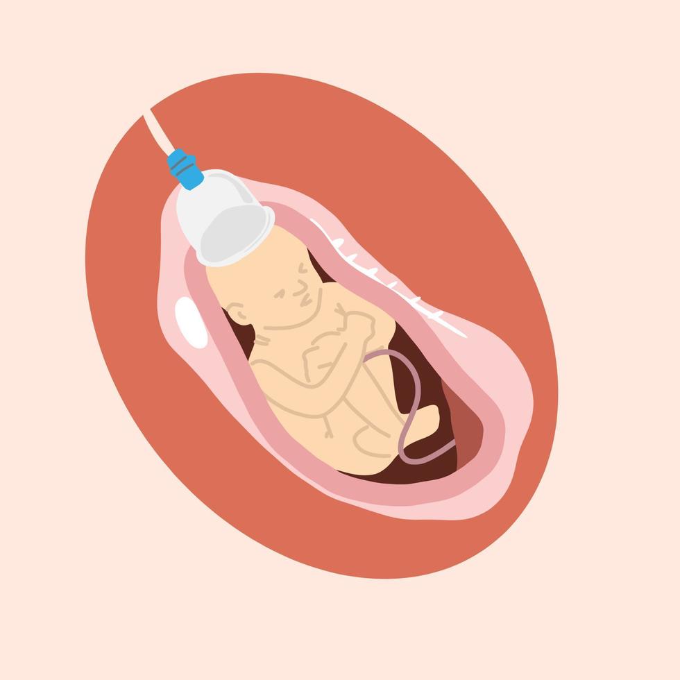 geboorte baby vacuümproces voor obgyn en medische inhoud vector