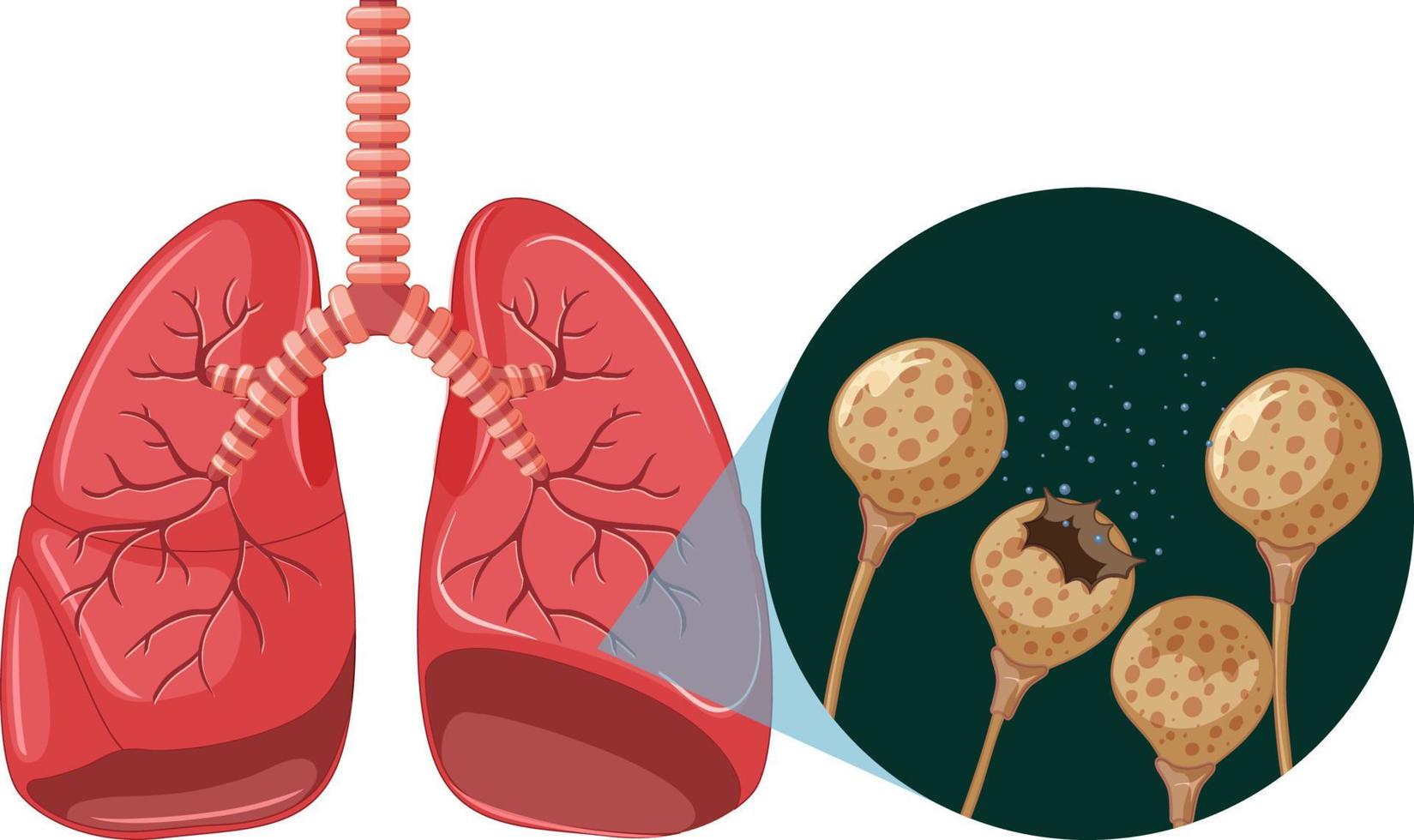 de schimmelsporen groeien in menselijke longen vector