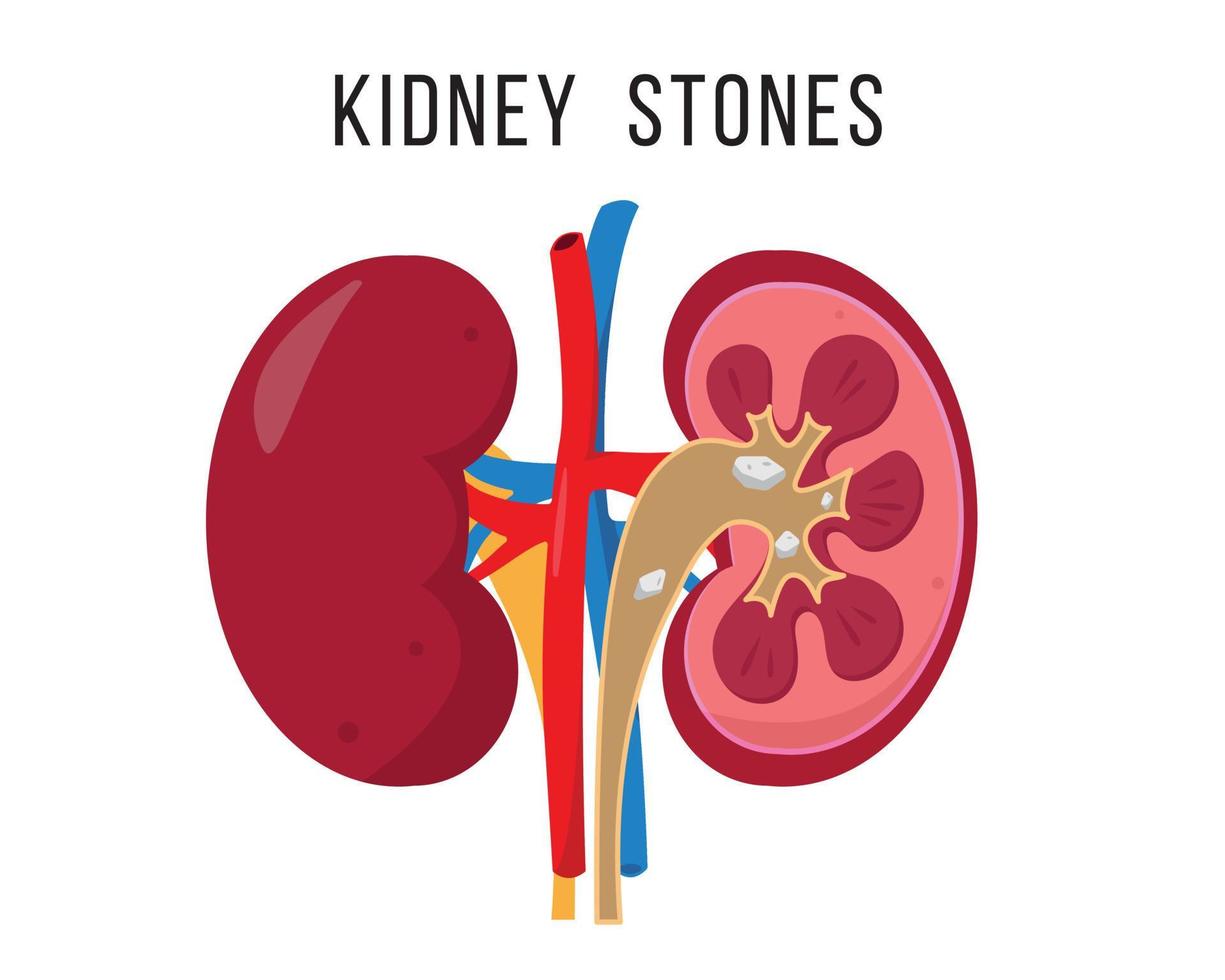 niersteenziekte. menselijke nieren anatomie binnen en buiten. inwendig orgel pictogram geïsoleerd op een witte achtergrond. medisch concept van ziek urinestelsel. vectorillustratie. vector