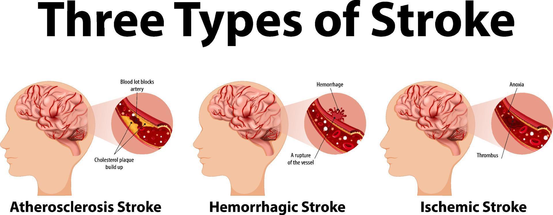 infographic van veelvoorkomende soorten beroertes vector