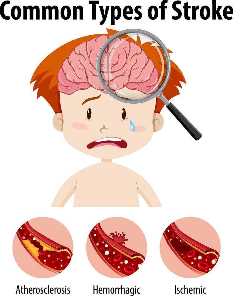 mens met veelvoorkomende soorten beroertes vector