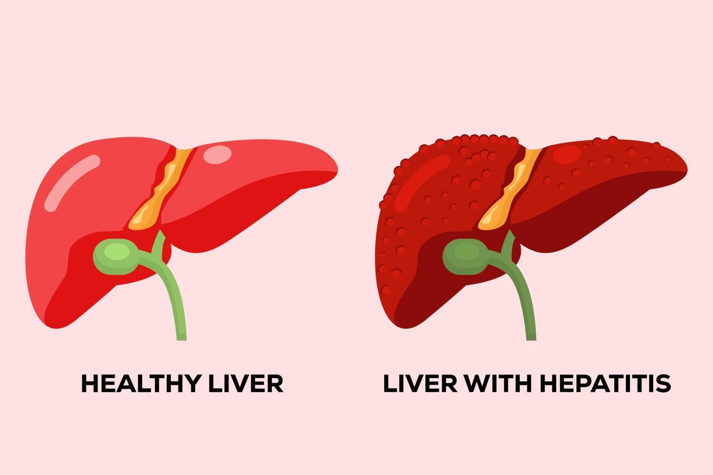 menselijke gezonde lever en menselijke lever met hepatitis vector