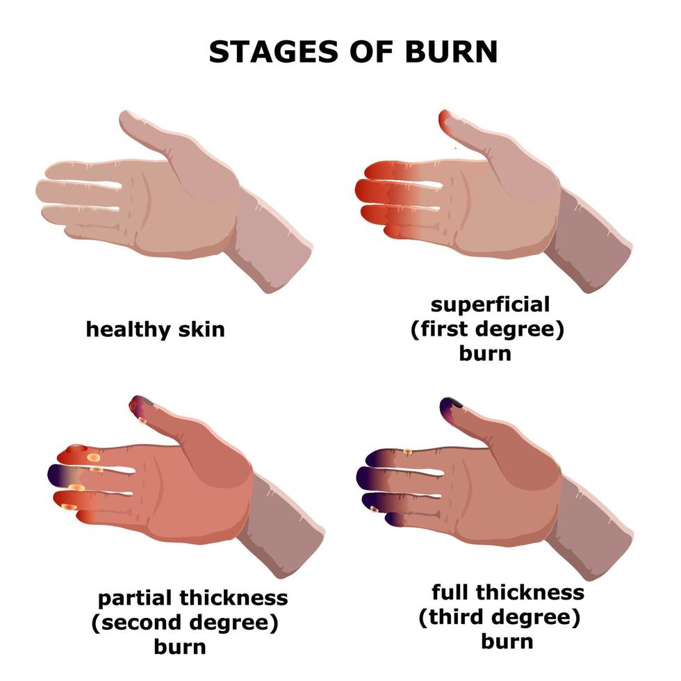 medische vectorillustratie. stadia verbranden. graads brandwonden van de huid. vector