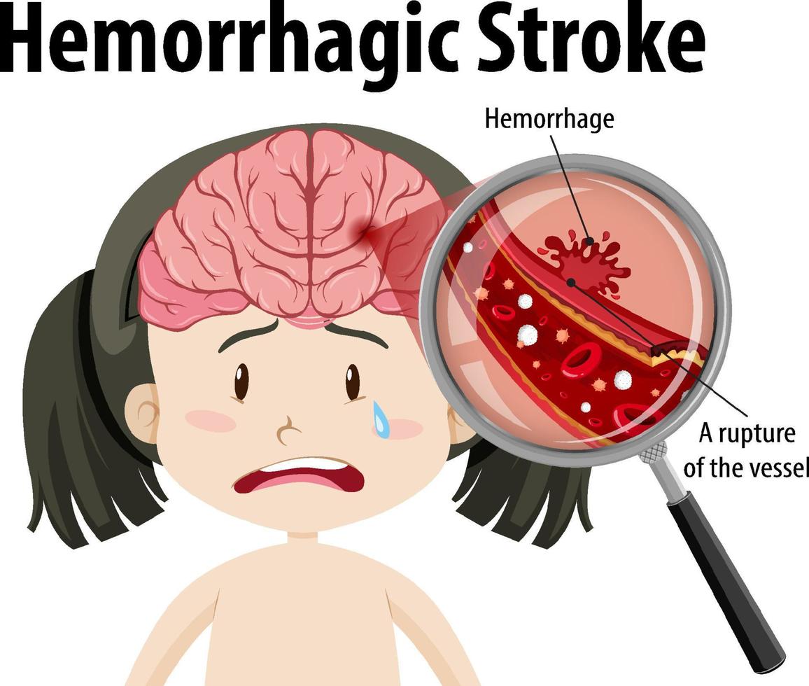 meisje met hemorragische beroerte vector