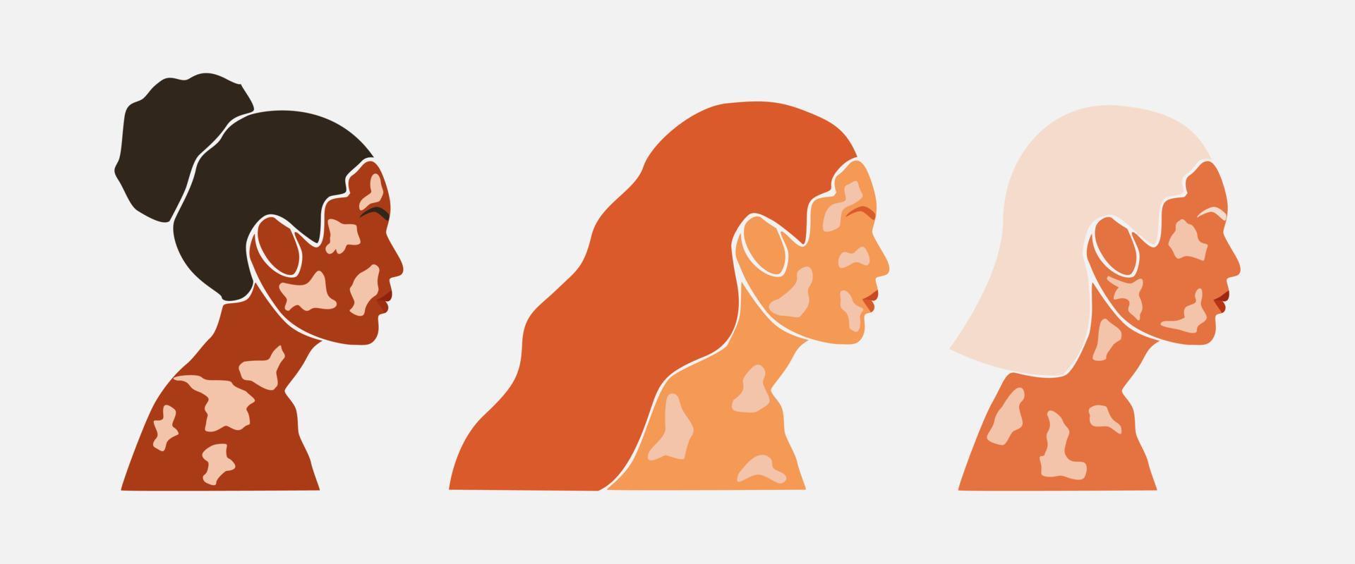 set van abstracte silhouet van schoonheidsvrouwen met witte pigmentatie. ondersteuning van het bewustzijn over chronische huidaandoening. wereld vitiligo dag. diversiteit tolerantie. mode papier gesneden illustratie vector