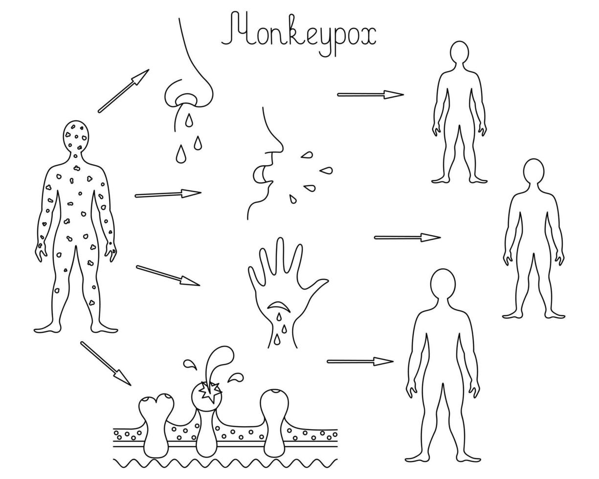 methoden voor menselijke infectie met apenpokken, overdracht van pokken van persoon op persoon vector