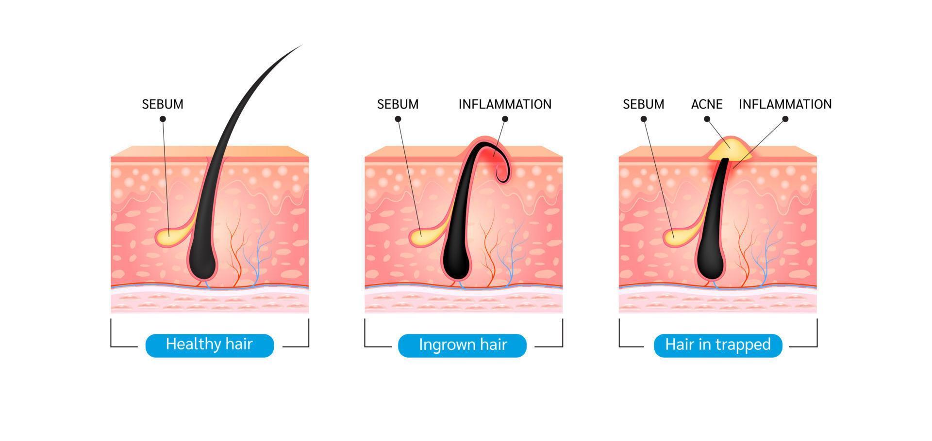 Ingegroeide haar. haar is na het scheren weer in het huidoppervlak gegroeid. vorming van huidacne of puistje. anatomie infographics van haar en huid. op een witte achtergrond. 3D-vectorillustratie. vector