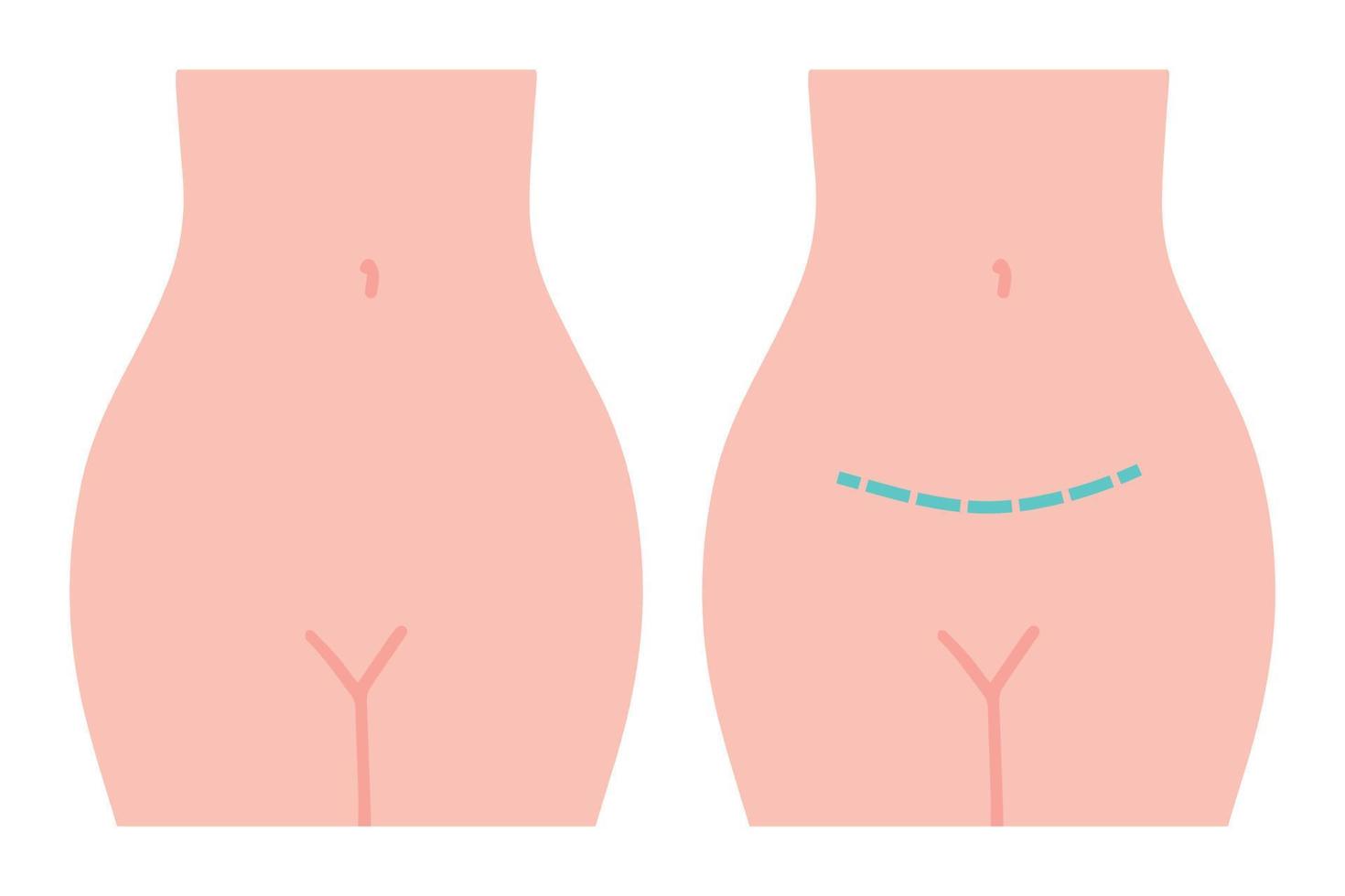 gynaecologische chirurgie, probleem met het voortplantingssysteem. vector