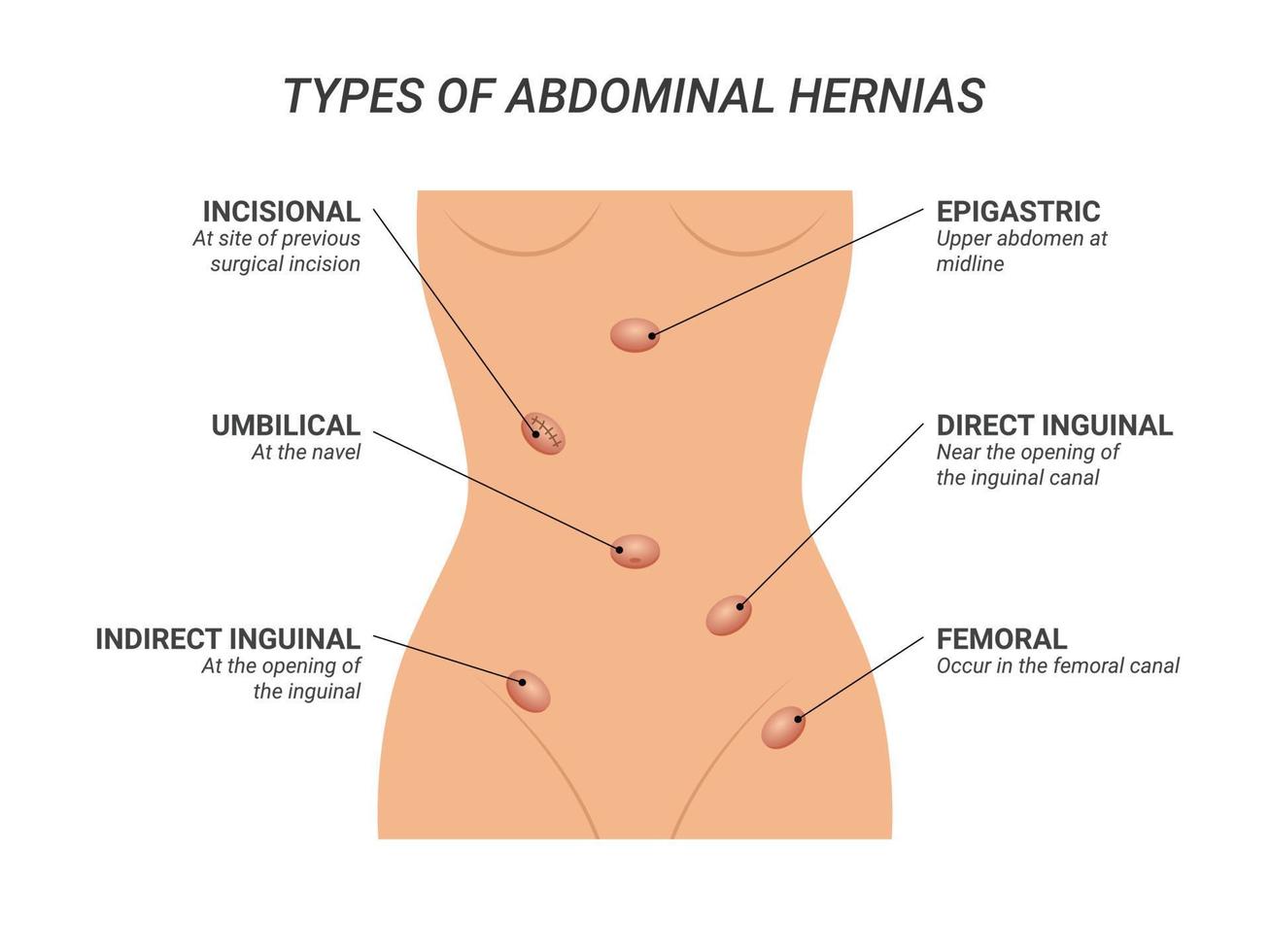 soorten abdominale hernia's illustratie op geïsoleerde achtergrond vector