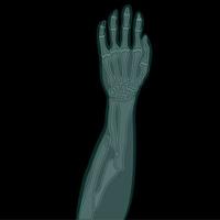 gebroken arm xrays vector illustratie