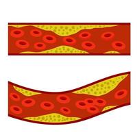 cholesterol in het bloed. aderen en slagaders met vet. vector