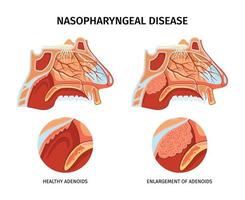 nasofaryngeale ziekte poster vector