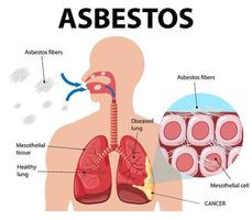 diagram met asbestose in de longen vector