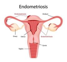 diagram van endometriose. ziekten van de vrouw voortplantings- systeem. vector illustratie in een vlak tekenfilm stijl.