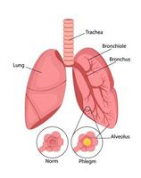 longontsteking. normaal en opruiend staat van de longen en ontsteking van de longblaasjes met vloeistof. vector illustratie in tekenfilm stijl geïsoleerd Aan wit achtergrond.
