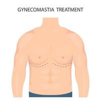 vector illustratie van gynaecomastie in Heren. voor reclame kunstmatig plastic procedures