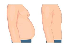 vector illustratie van gynaecomastie in mannen voordat en na behandeling. menselijk borst in een halve draai