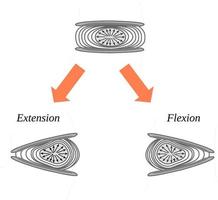 vervorming van de tussenwervel schijf ten gevolge flexie en uitbreiding beweging vector