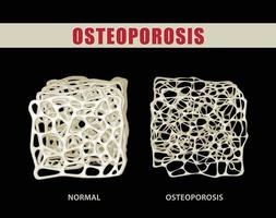 3d illustratie vergelijken osteoporose met normaal bot Aan zwart achtergrond. vector