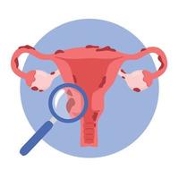 illustratie van de baarmoeder en endometriose. vrouwen ziekten, gynaecologisch examen en het voorkomen van vrouwen Gezondheid. vector