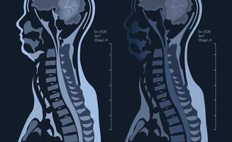 mri van de cervicaal wervelkolom met en zonder contrast, mri met bilateraal c7 wortel compressie, cervicaal spondylose vector