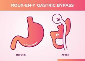 roux nl y maag- omzeilen rny gewicht verlies chirurgie vector illustratie icoon