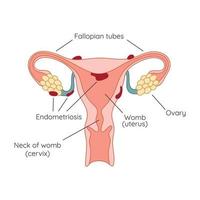 endometriose. de uiterlijk van de ziekte endometriose. endometrium. infographic vector