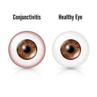 conjunctivitis. rood oog. gezond oog vector