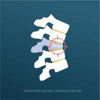 osteoporotisch wervel compressie breuk vector