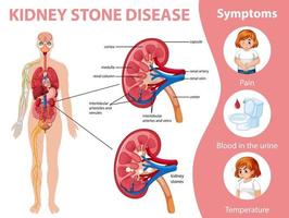 nierstenen ziekte en symptomen infographic vector