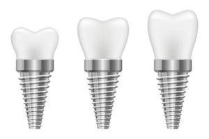 tand implantaat vector ontwerp illustratie geïsoleerd op een witte achtergrond