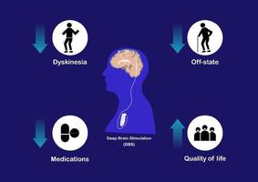 concepten van diep hersenen stimulatie voor behandeling van parkinson ziekte. vector